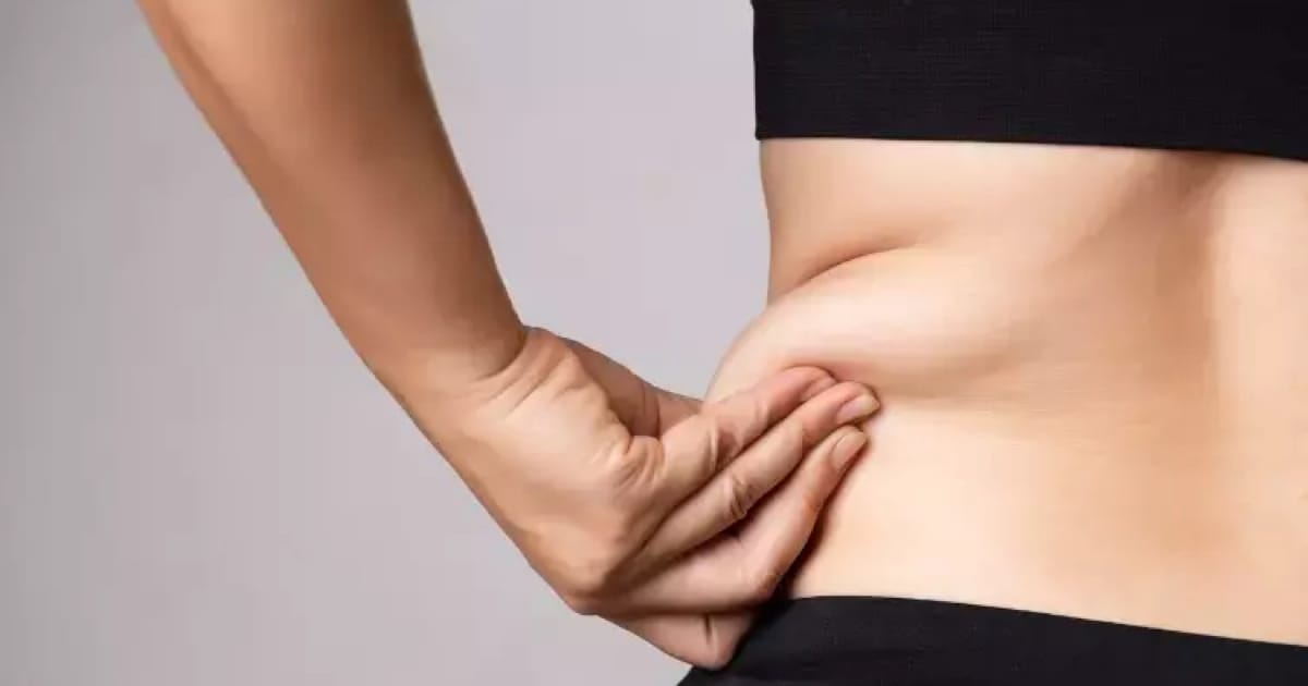 Obezite Ameliyatı Sonrası Sarkma Nasıl Engellenir?