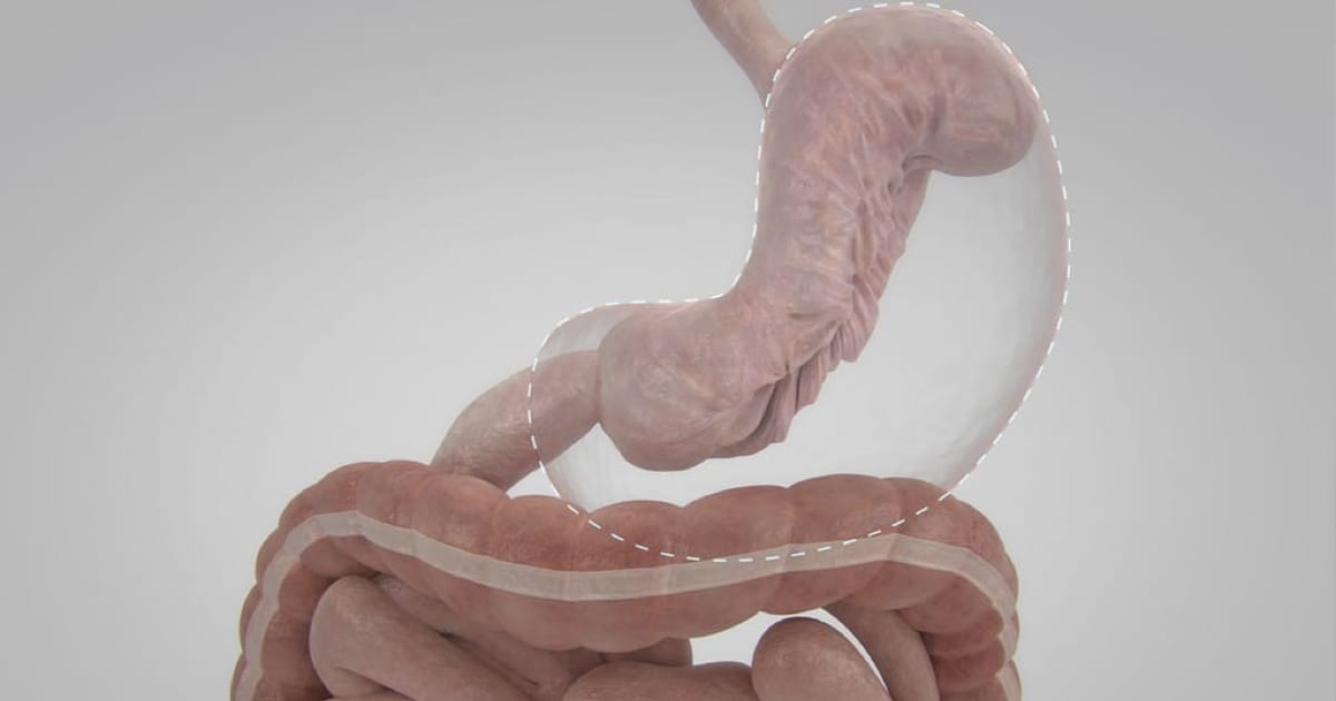 Endoskopik Tüp Mide (Ameliyatsız Tüp Mide)