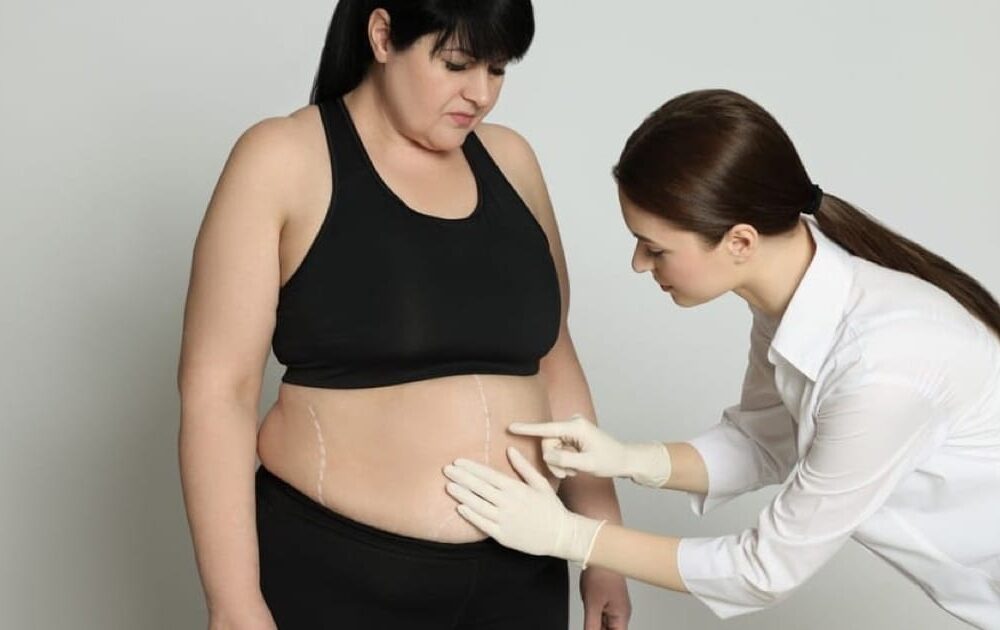 Bariatrik Cerrahi Sonrası Kilo Kaybını Etkileyen Başlıca Faktörler