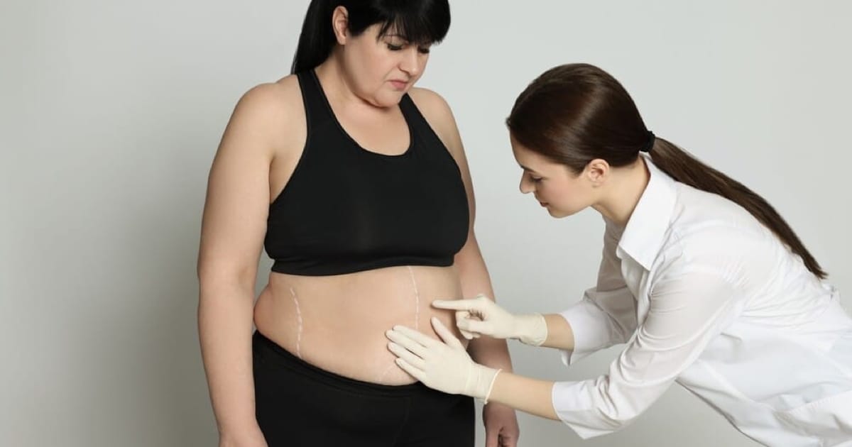 Bariatrik Cerrahi Sonrası Kilo Kaybını Etkileyen Başlıca Faktörler